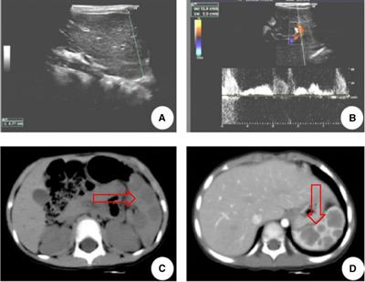 Case report and literature review: Asymptomatic littoral cell angioma in a 3-year-old girl